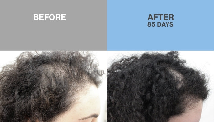 HAIR REGROWTH SOLUTION