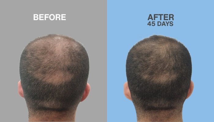 HAIR REGROWTH SOLUTION