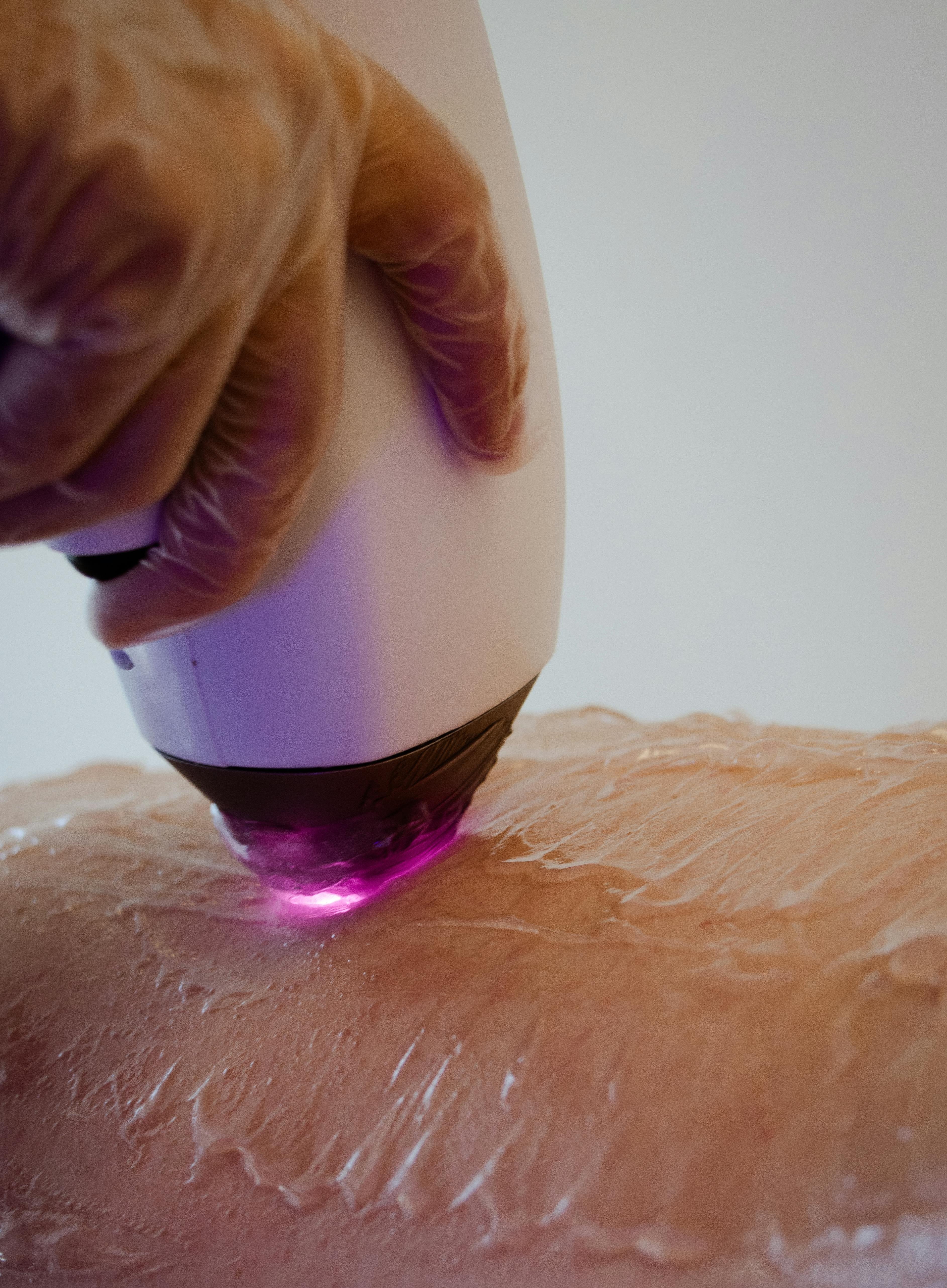 Laser Hair Removal
